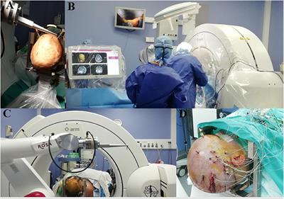 Indications, Techniques, and Outcomes of Robot-Assisted Insular Stereo-Electro-Encephalography: A Review